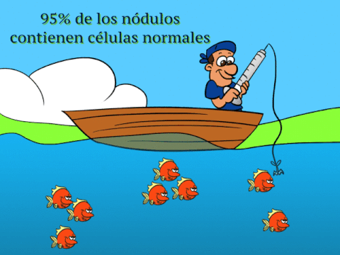 resultados de biopsia de nódulo tiroideo: el 95% de los nódulos tiroideos contienen células normales
