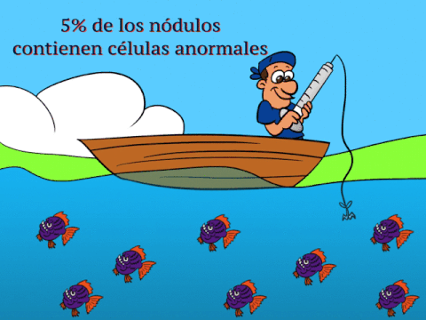 resultados de biopsia de nódulo tiroideo: el 5% de los nódulos tiroideos contienen células anormales