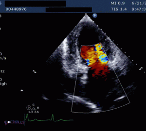 Leaky valve causing murmur
