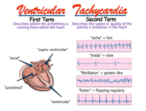 How arrhythmias are named