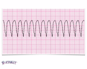 Ventricular Tachycardia