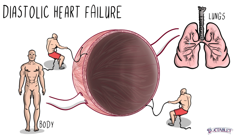 Diastolic heart failure happens when the heart cannot relax well