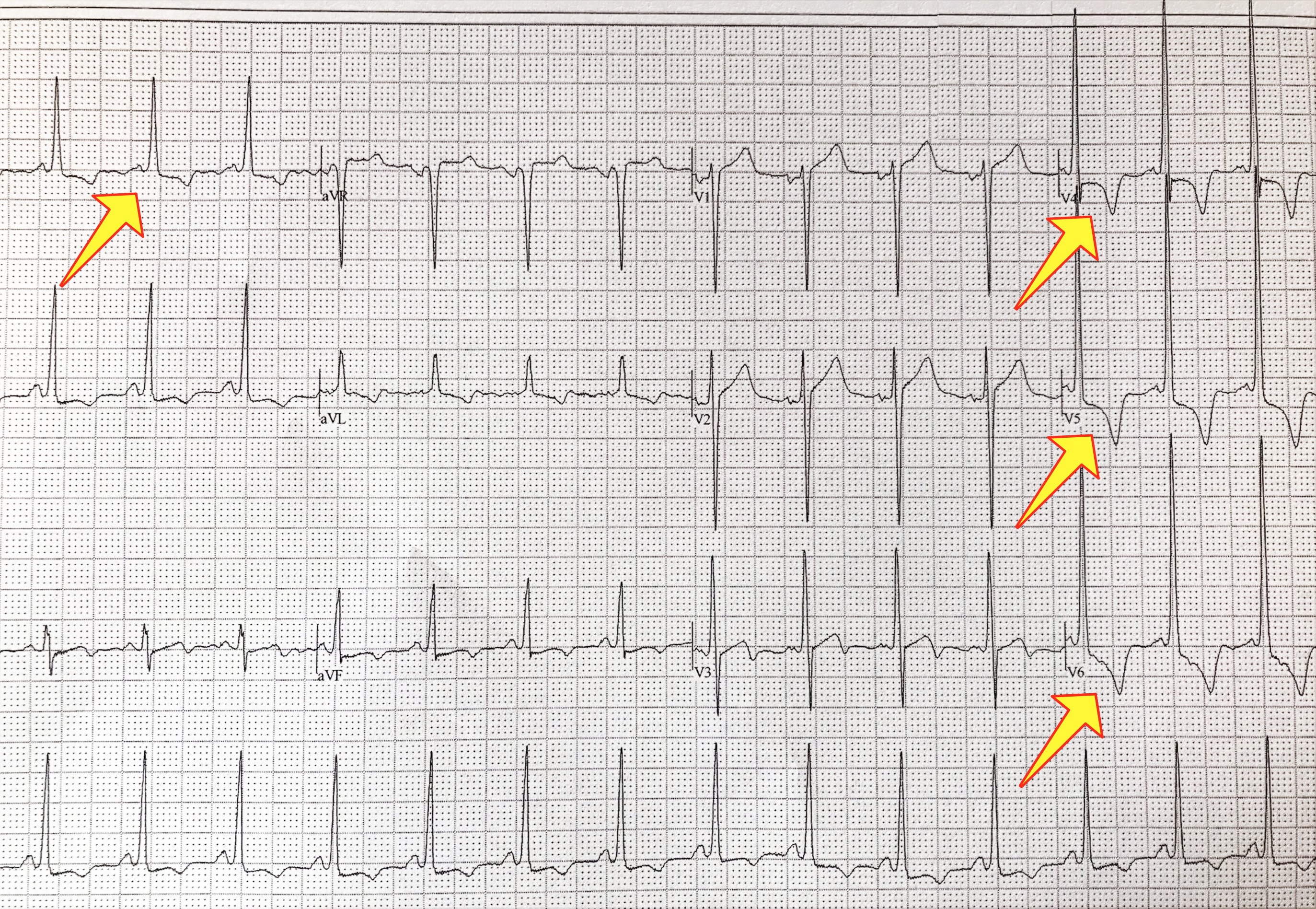 ECG Characteristic of hyperthorphic cardiomyopathy