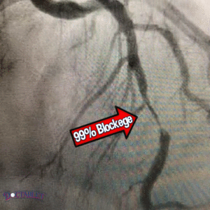 99% blockage in the Left Anterior Descending Artery of a patient with Wellens's syndrome. 