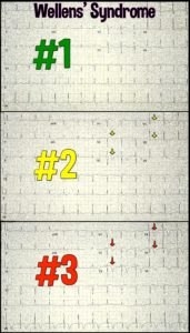 Wellens' Sign, Wellens' Syndrome