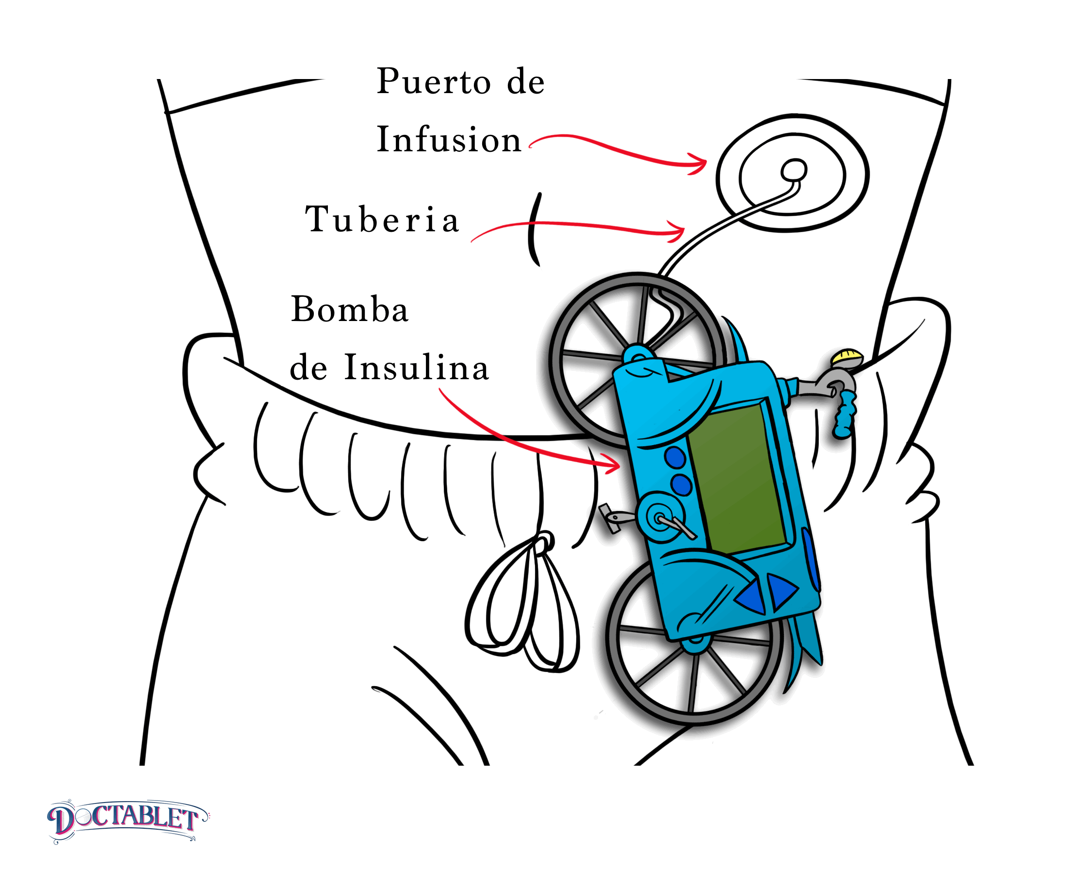 En una bomba de insulina la insulina fluye desde un depósito y viaja por un tubo que se conecta al cuerpo del paciente. Esta pequeña parte de plástico flexible de la bomba es la forma en que la insulina entra en el cuerpo.
