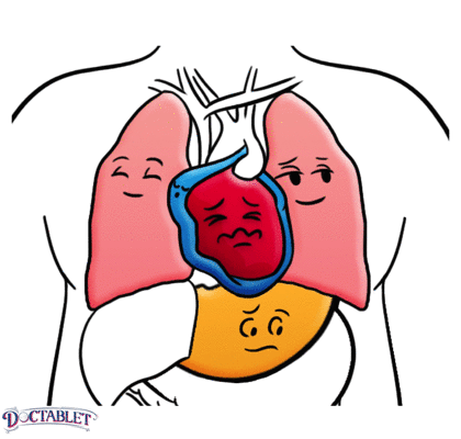 Que es un ataque al corazón silencioso? es pequeño u ocurre lentamente y pasa desapercibido. 