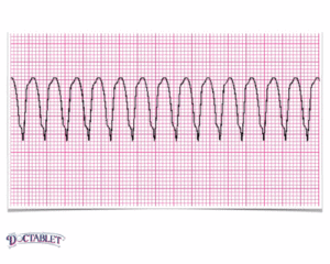 Tachycardia Ventricular