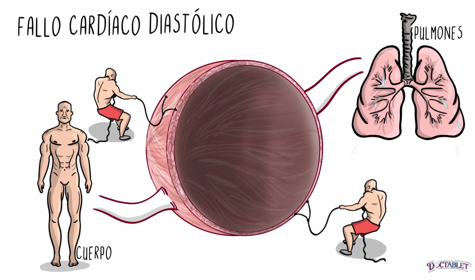 El fallo cardíaco diastólico (disfuncion diastolica)  ocurre cuando el corazón no se relaja bien