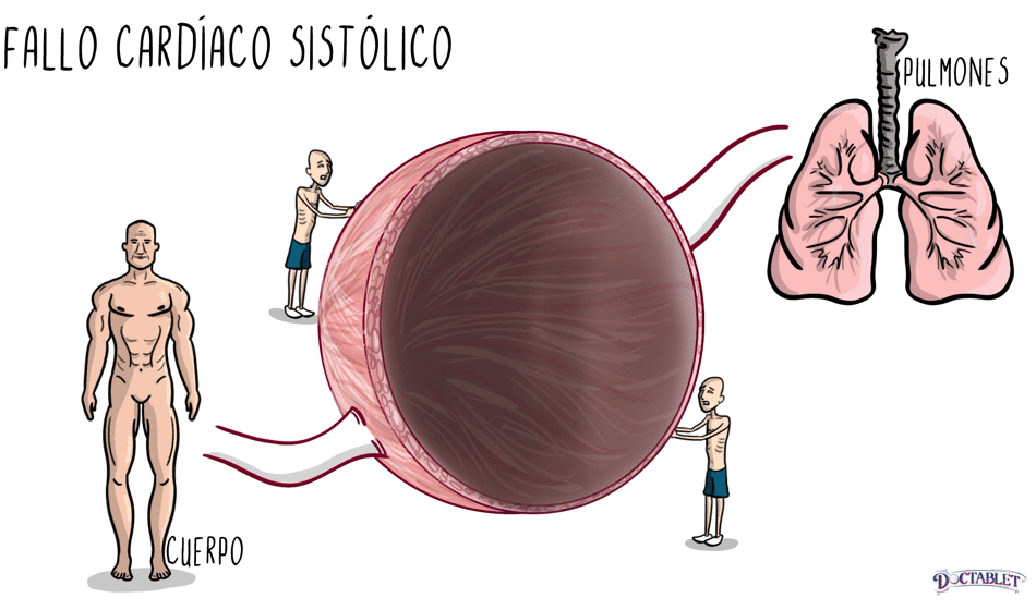 El fallo cardíaco sistólico ocurre cuando el corazón no comprime bien.