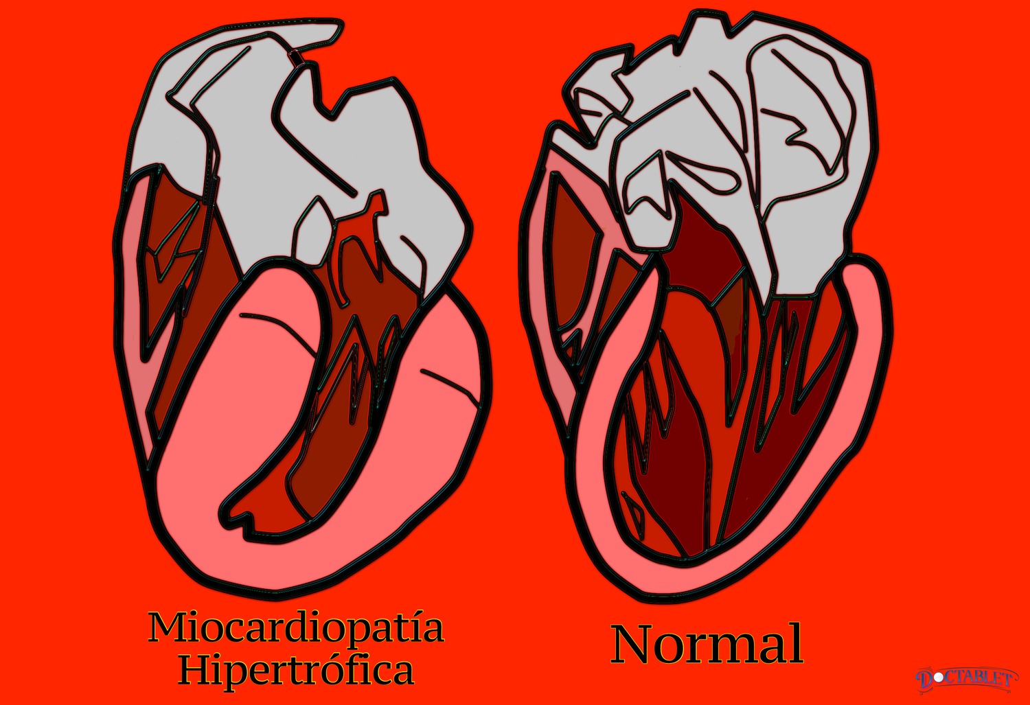  Miocardiopatía hipertrófica (MCH) vs. un corazón normal