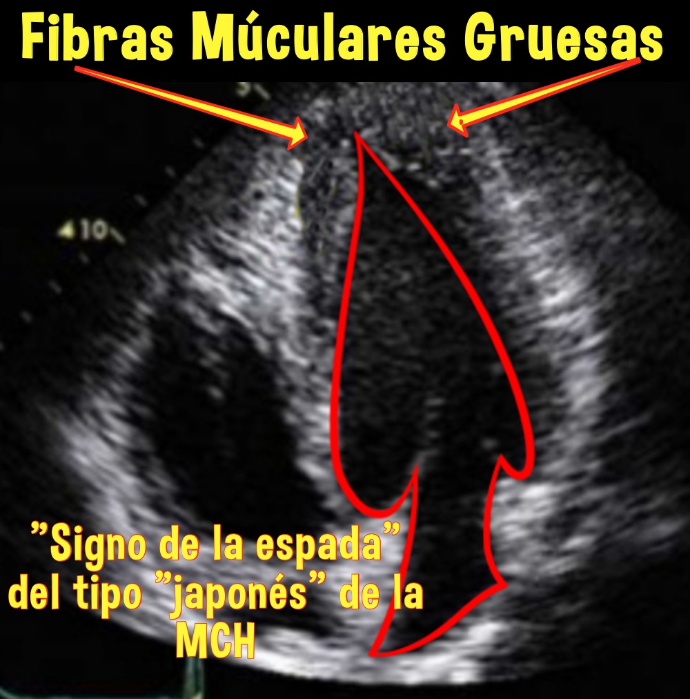 El signo de espada de la miocardiopatía hipertrófica apical