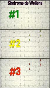 Síndrome de Wellens