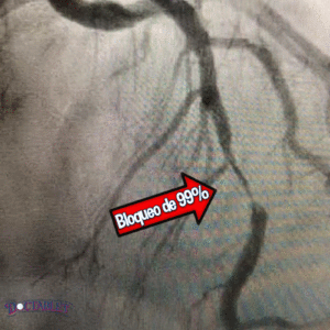 99% de bloqueo en la arteria anterior descendente de un paciente con Wellens