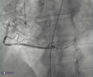 Angiografia Cardiaca animazione