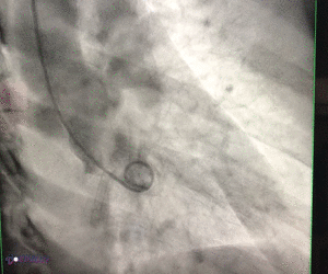 ventriculograma animacion