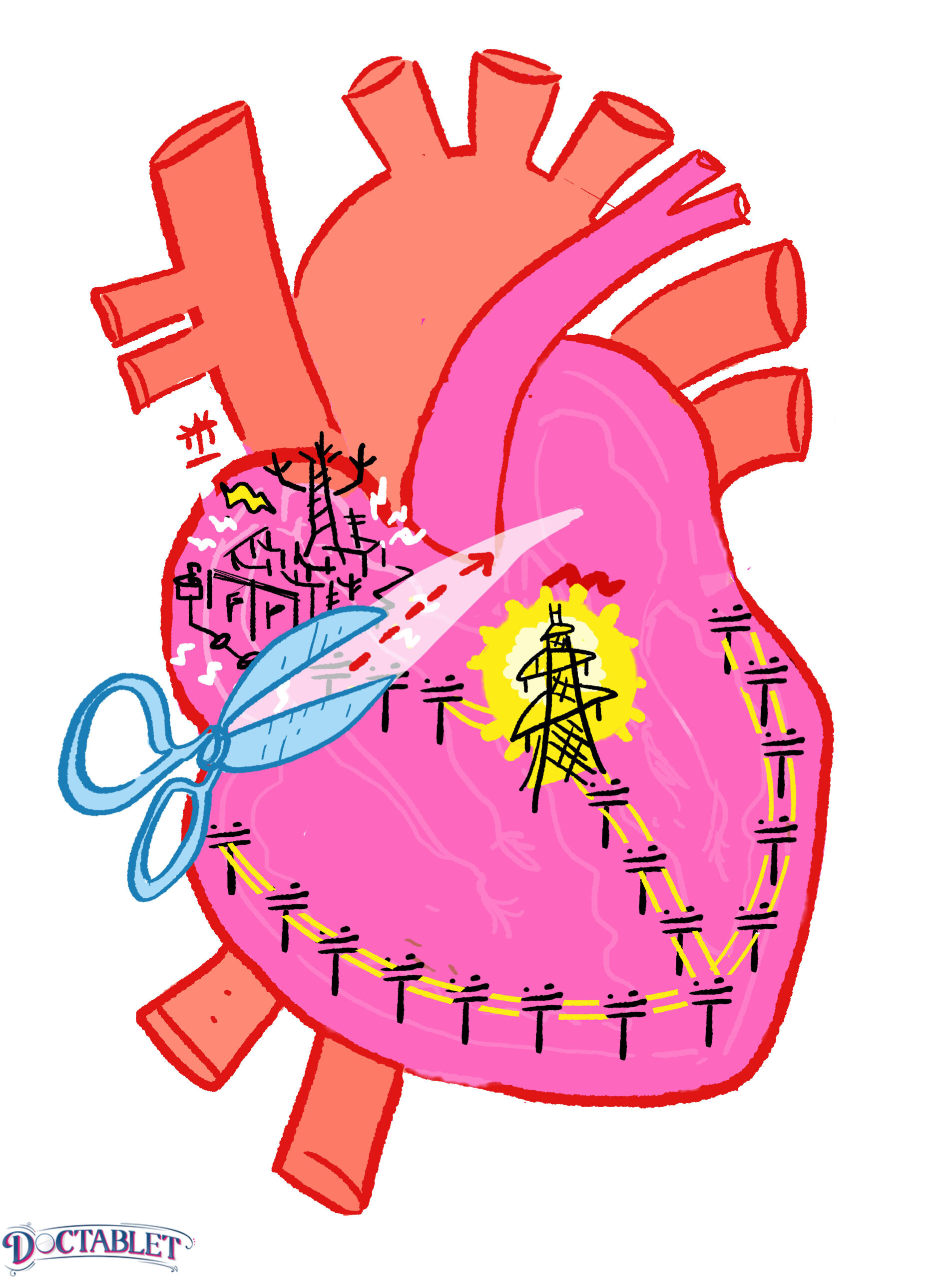 Bloqueo de primer grado - Doctablet