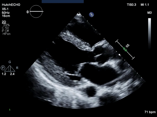 Hipertrofia Ventricular Izquierda