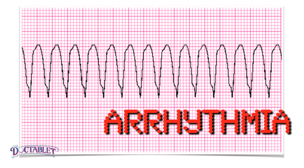 What is an Arrhythmia
