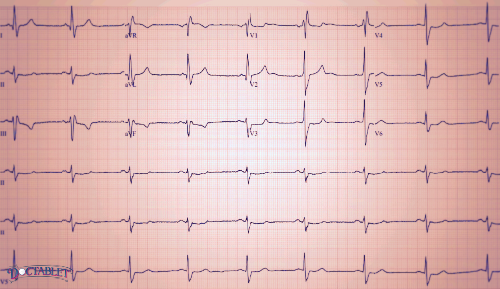 ECG, EKG, Electrocardigram