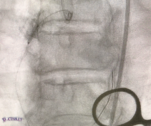 Coronary Angioplasty Animation