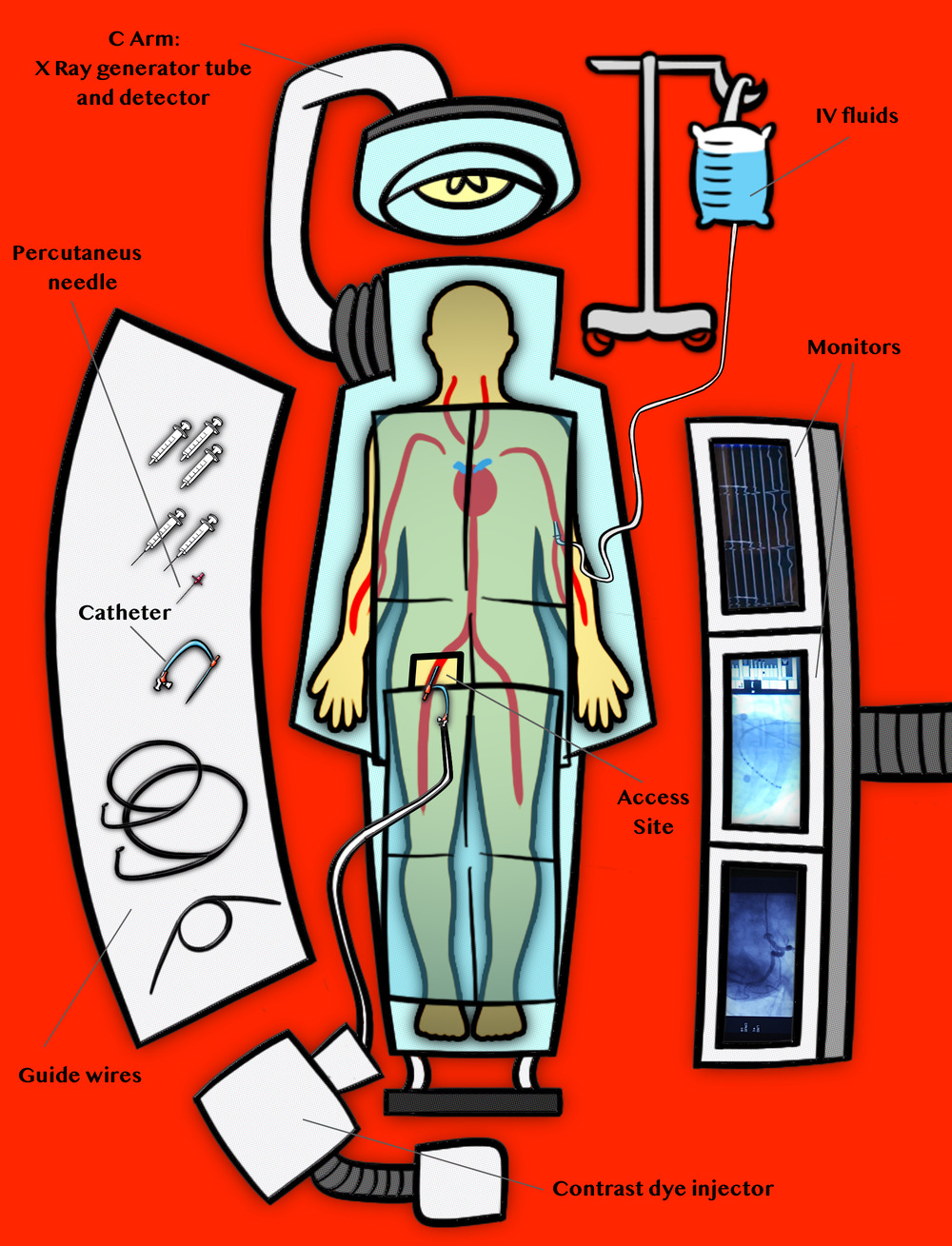 Cardiac Catheterization Laboratory Diagram - Doctablet