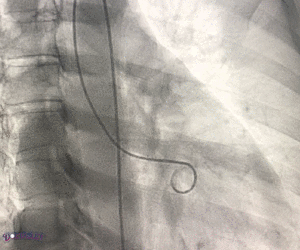 Aortogram Gif