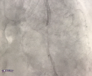 Percutaneous coronary intervention