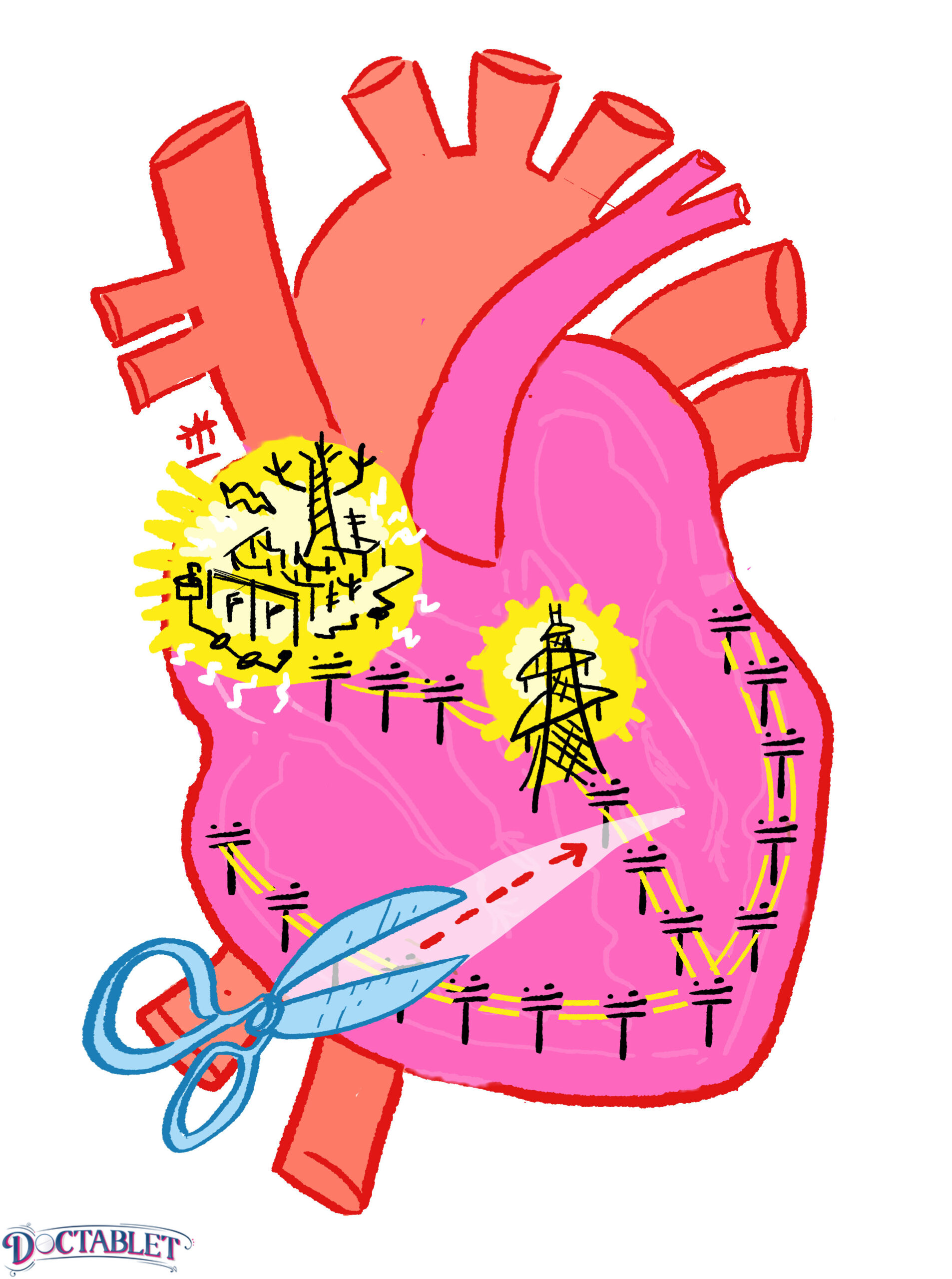 Third degree AV block - Doctablet