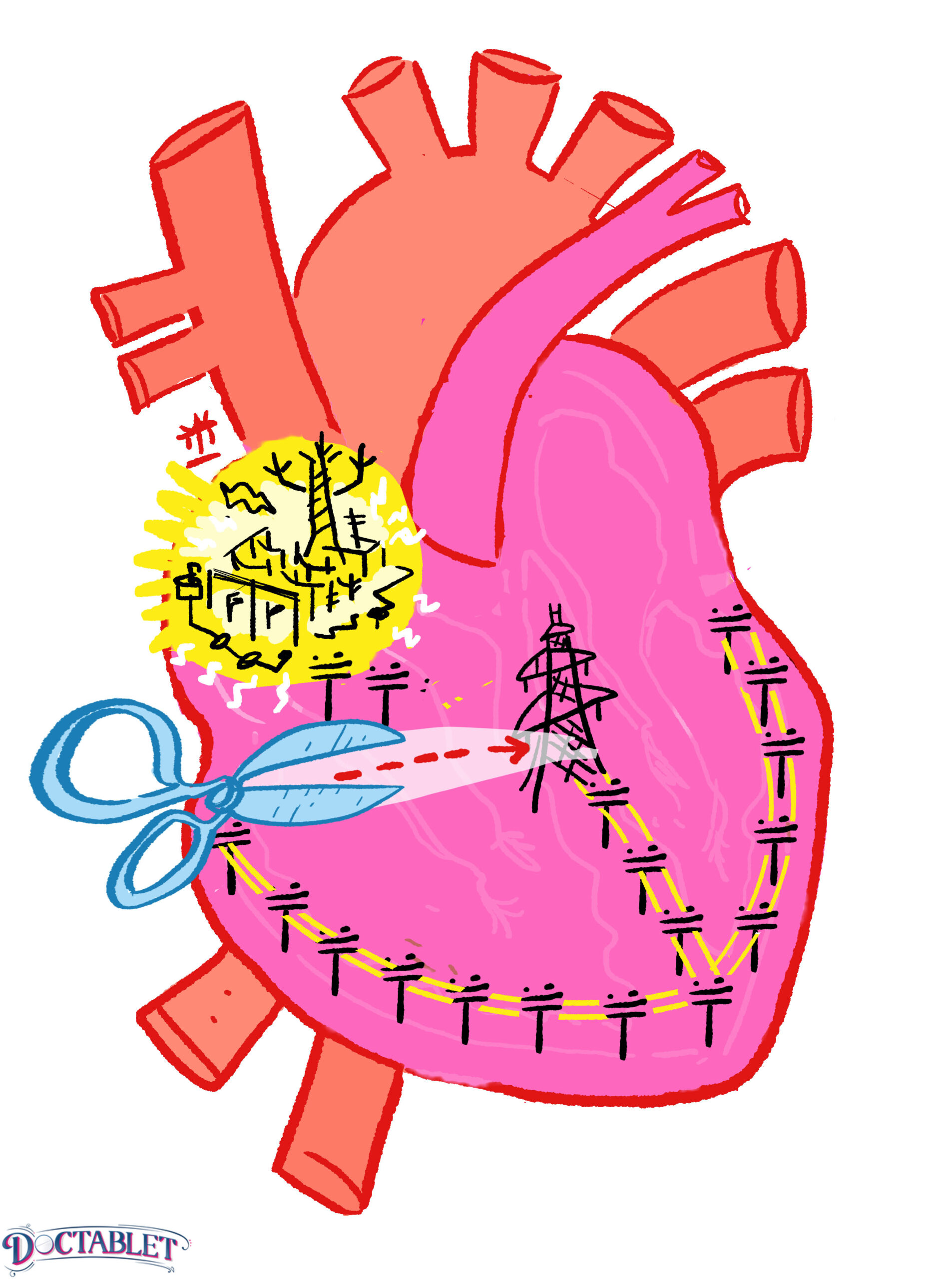 Second degree AV block - Doctablet