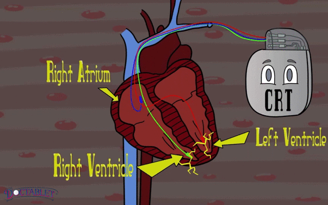 Cardiac Resynchronization Animation